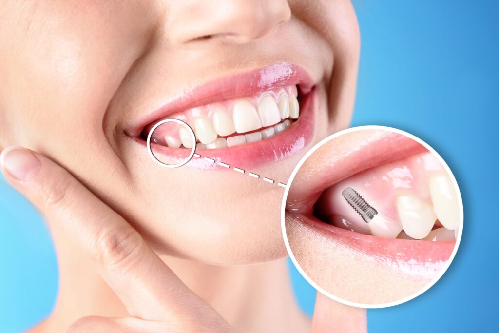 Nose-to-neck view of woman touching her cheek smiling with one tooth indicated as an implant