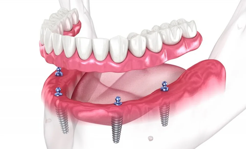 Illustration of All-on-6 dental implants supporting a full arch