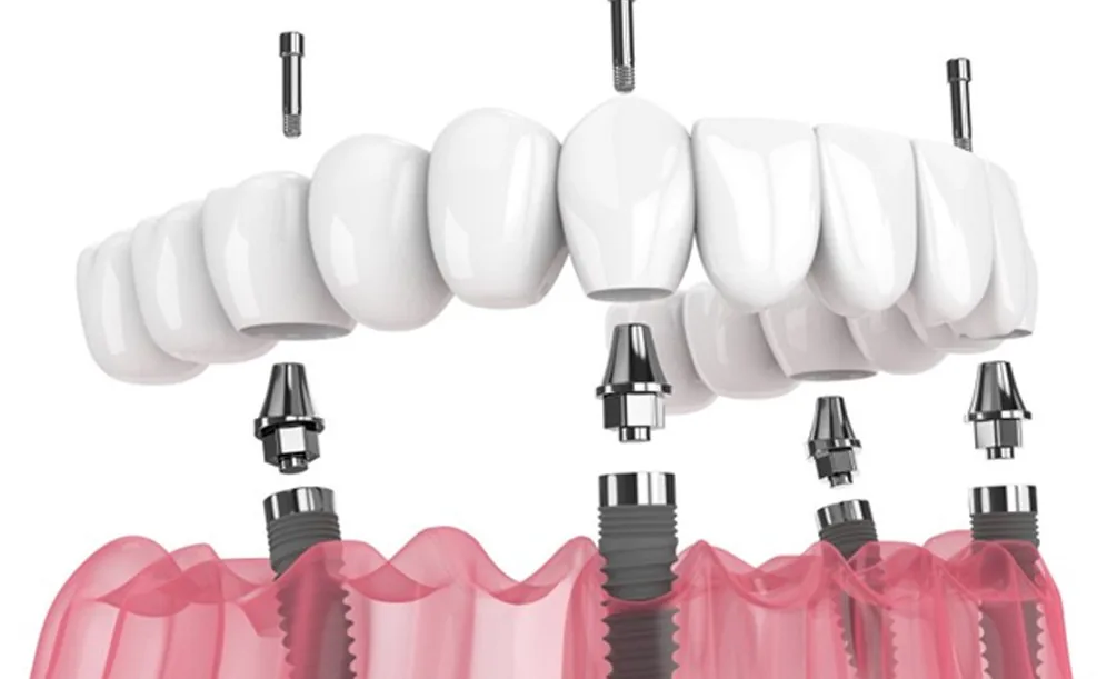 3D illustration of All-on-6 dental implants