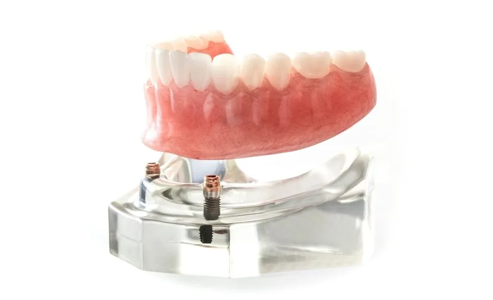 Implant-supported dentures