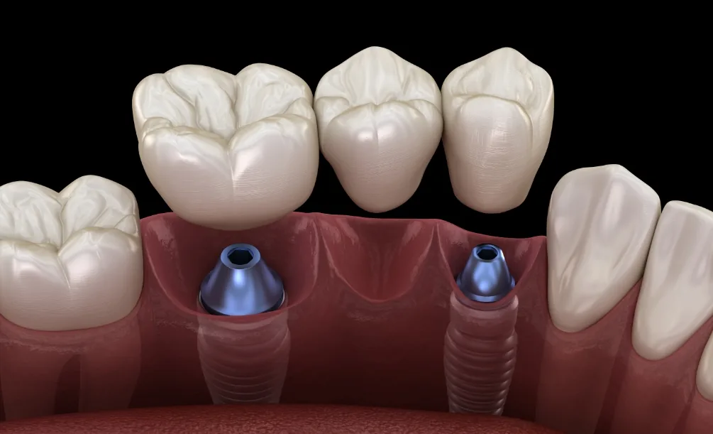 Dental bridge being placed over two dental implants in the lower jaw