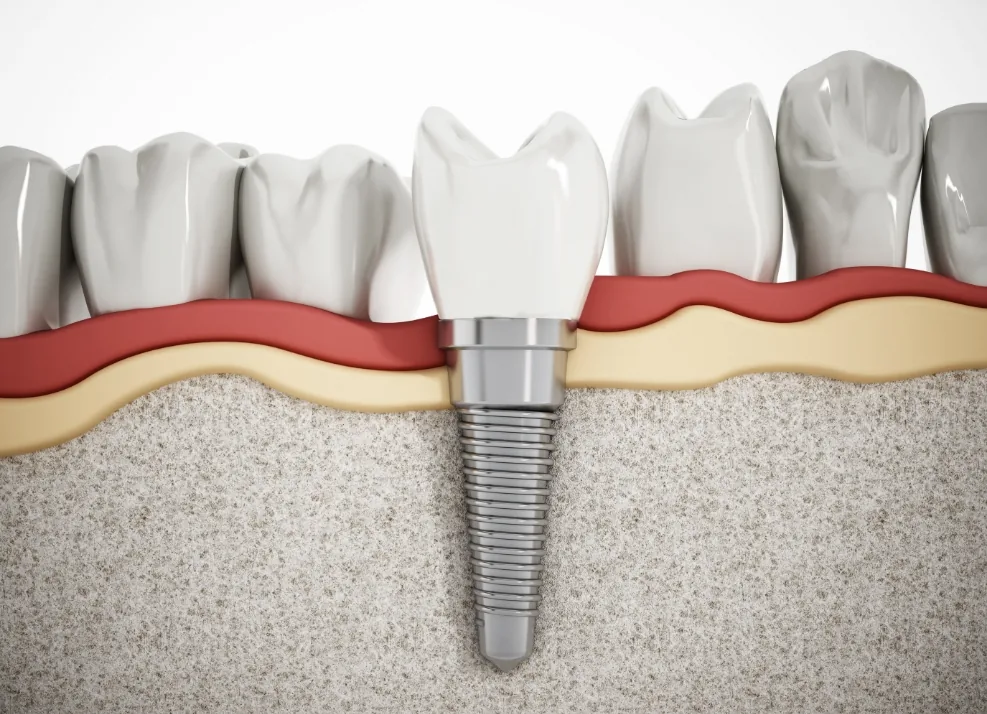 Dental implant with a crown in the lower jaw