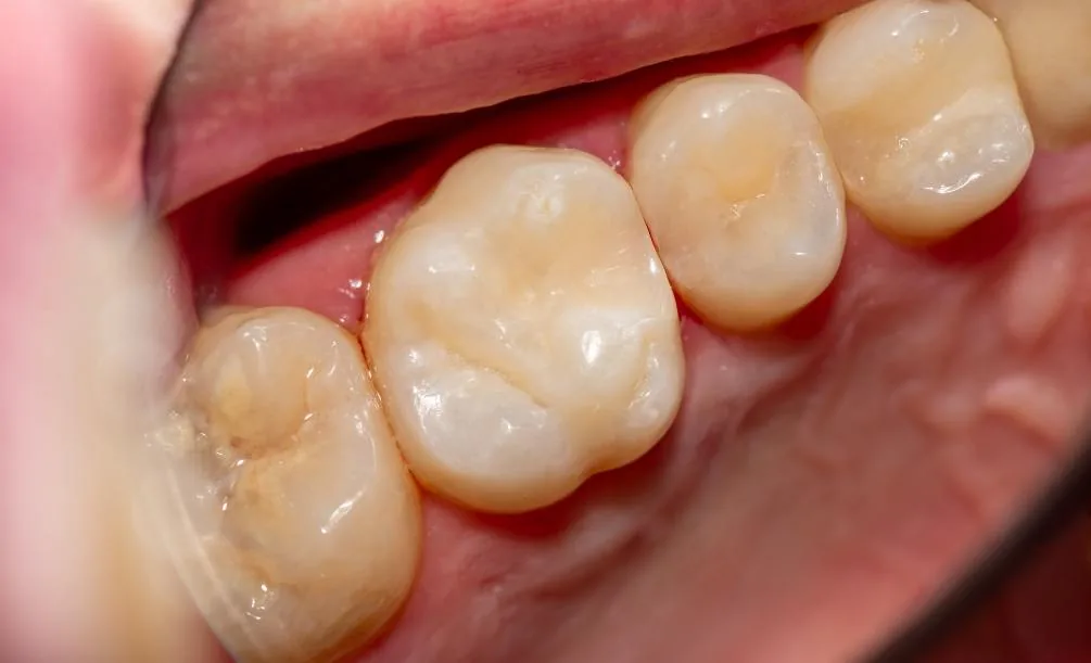 Close-up of a tooth with a tooth-colored filling