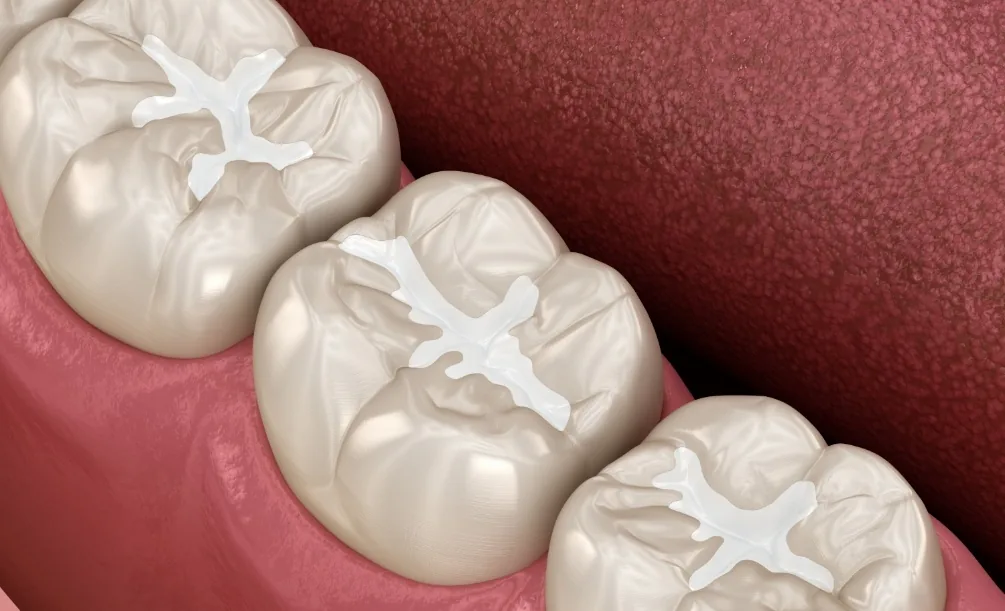 Illustration of dental sealants on teeth