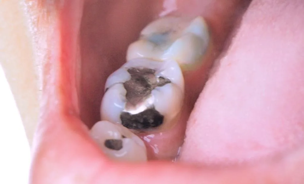 Close-up of teeth with dark gray amalgam fillings