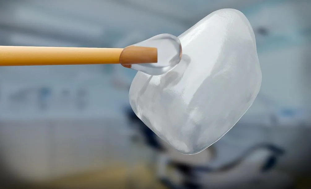 Closeup of a porcelain veneer held with dental cement