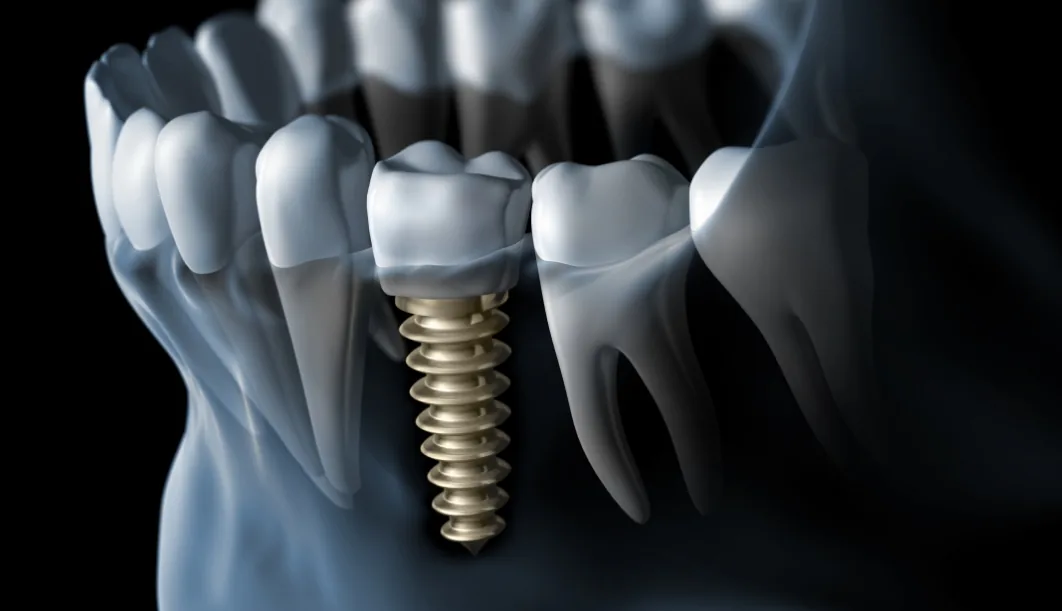 Animated X-ray of a dental implant