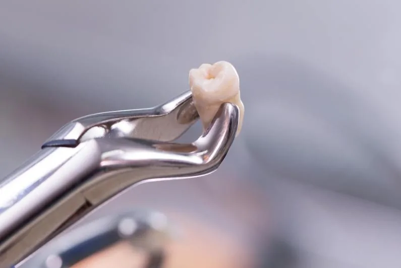 Dental forceps holding a removed tooth