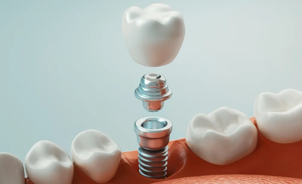 Dental implant placed in the lower jaw