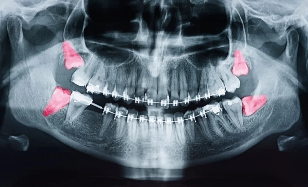 Dental X-ray showing wisdom teeth