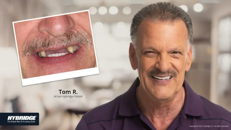 Before and after Hybridge implant result for Tom R.