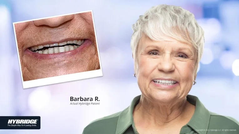 Before and after Hybridge implant patient result