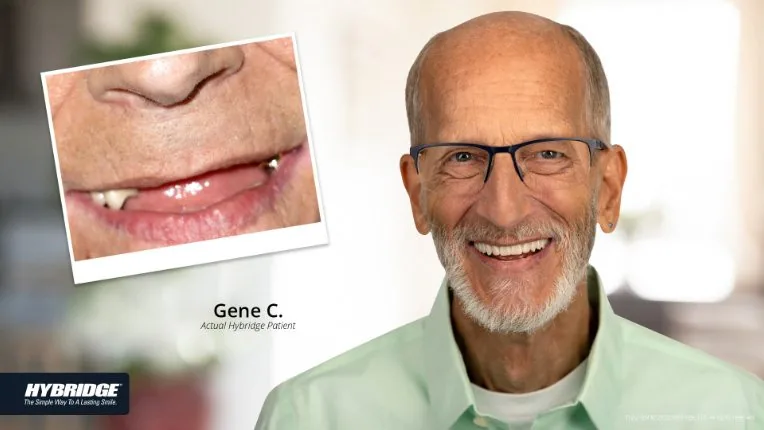 Before and after Hybridge implant patient result