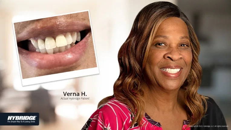 Before and after Hybridge implant patient result