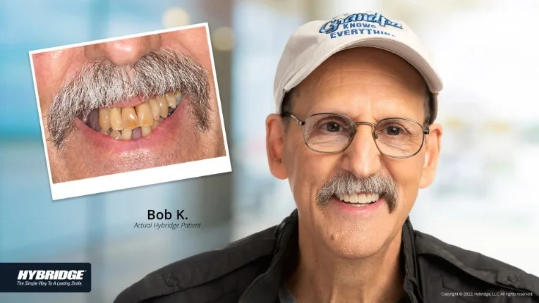 Before and after Hybridge implant patient result