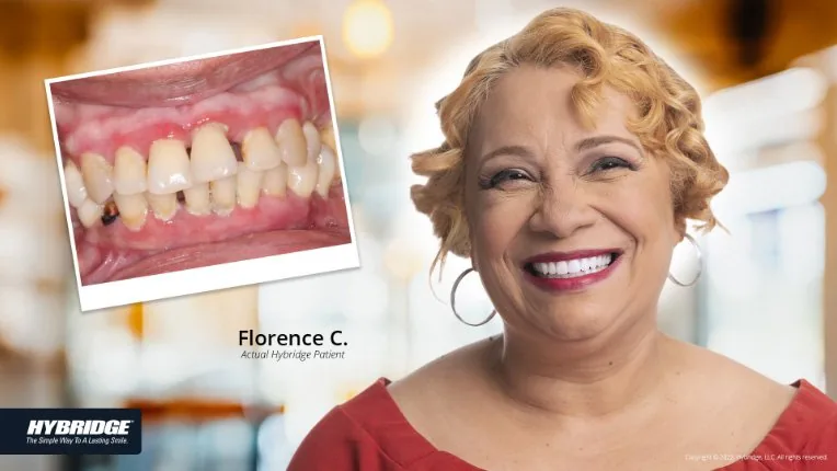 Before and after Hybridge implant patient result
