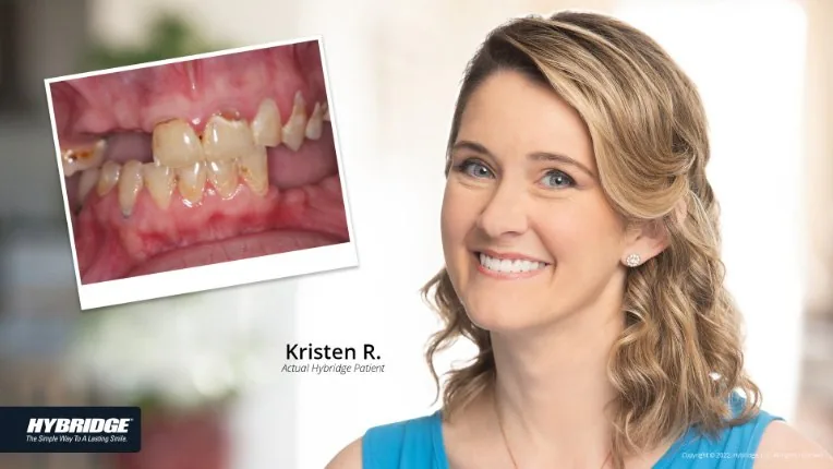 Before and after Hybridge implant patient result