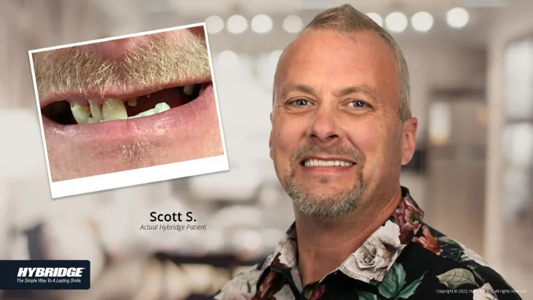Before and after Hybridge implant patient result