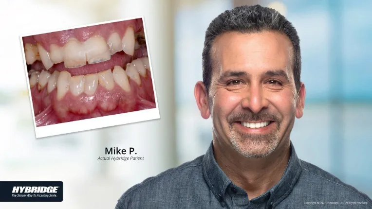Before and after Hybridge implant result for Mike P.