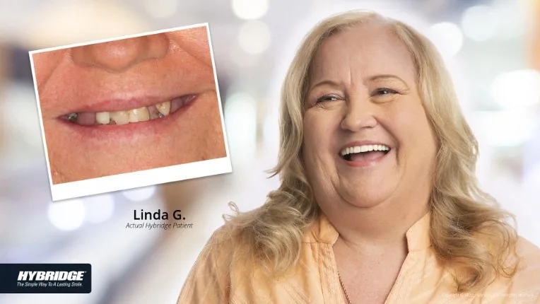 Before and after Hybridge implant result for Linda G.