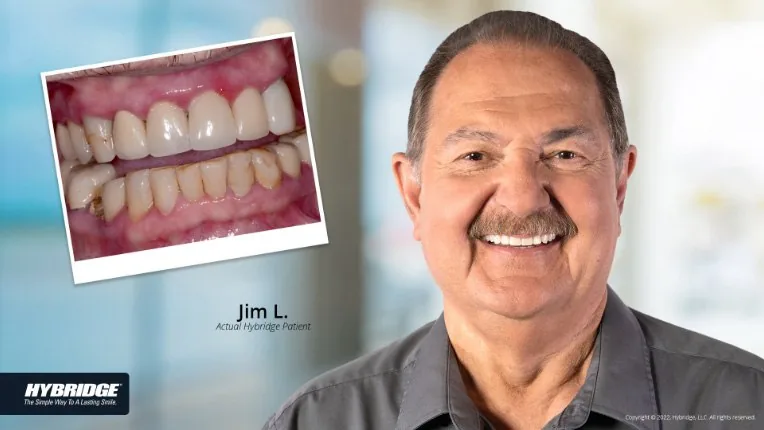 Before and after Hybridge implant patient result