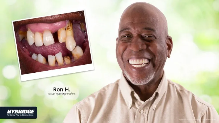 Before and after Hybridge implant patient result