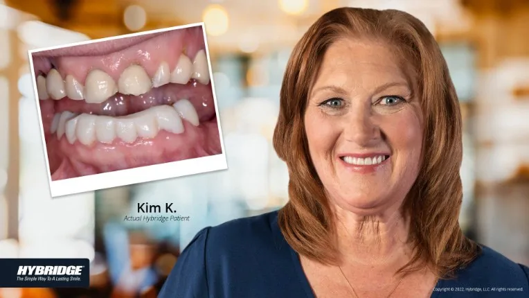 Before and after Hybridge implant patient result