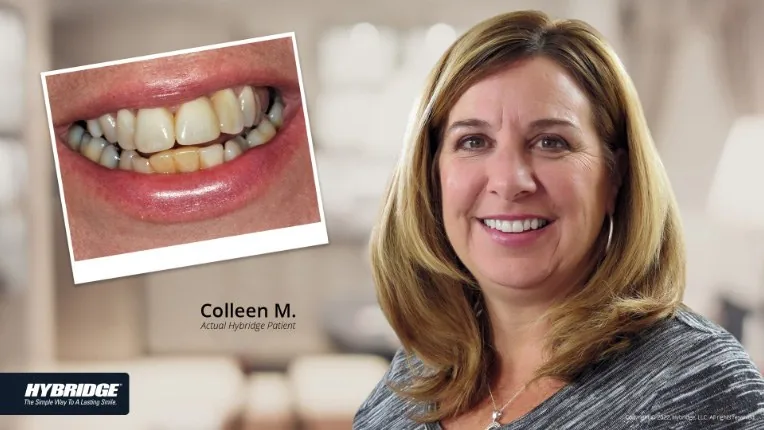 Before and after Hybridge implant patient result