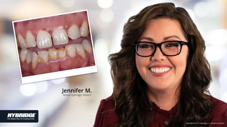 Before and after Hybridge implant patient result
