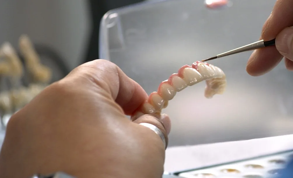 Upper Hybridge full-arch denture