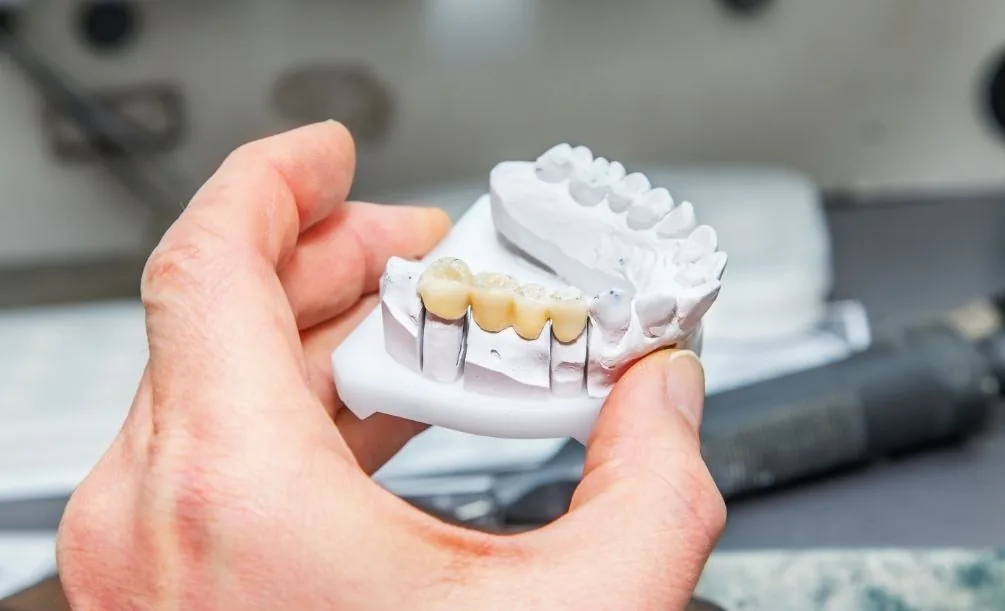 Person holding a model of a jaw with a dental bridge